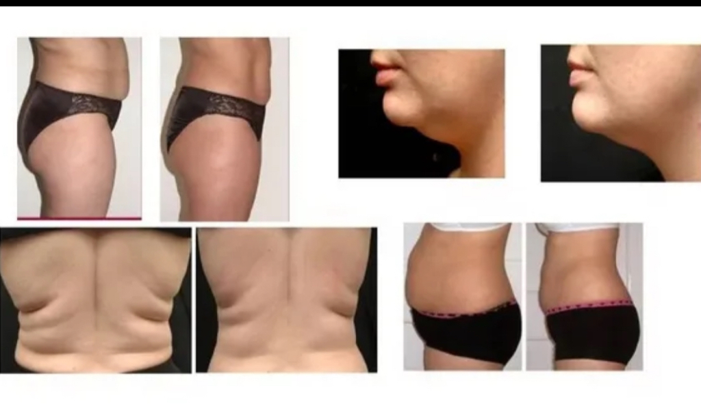 Липолиз тела