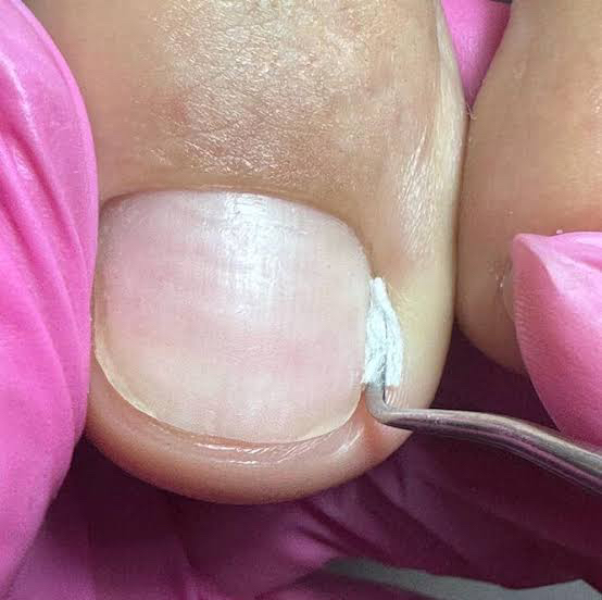 Работа с вросшими ногтями при педикюре (тампонада)