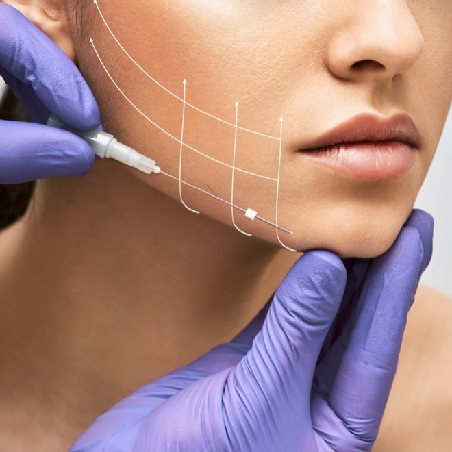 Нитевой лифтинг