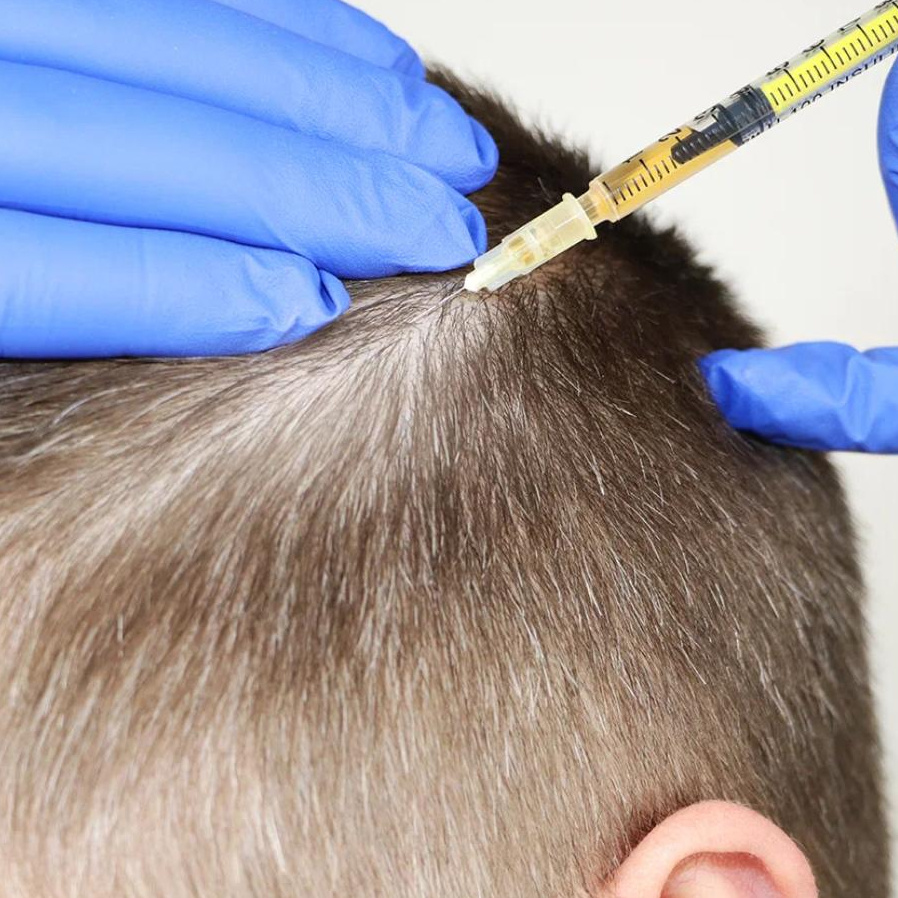 Лечение выпадение волос у мужчин PRGP-терапия