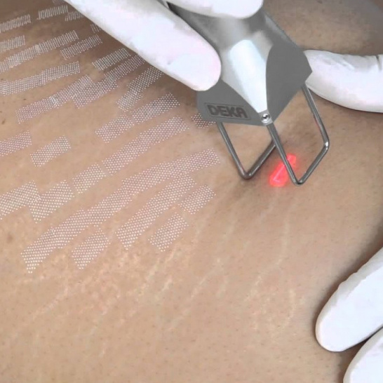 Лазерная шлифовка растяжек