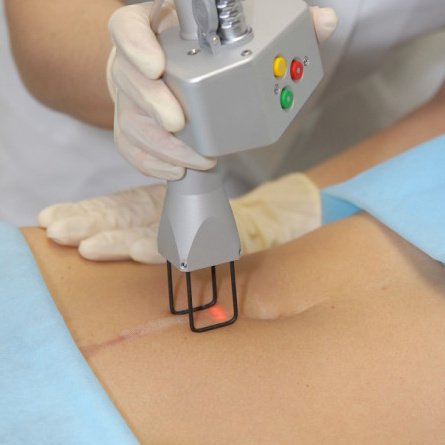 Лазерная шлифовка рубцов