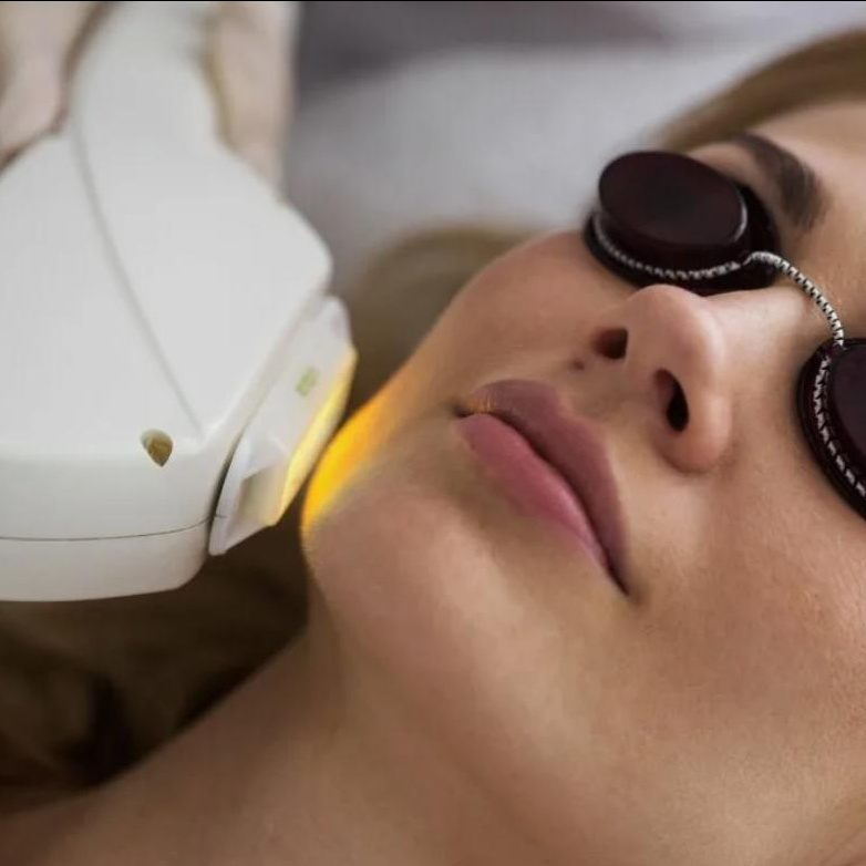 Лечение розацеа ( IPL)