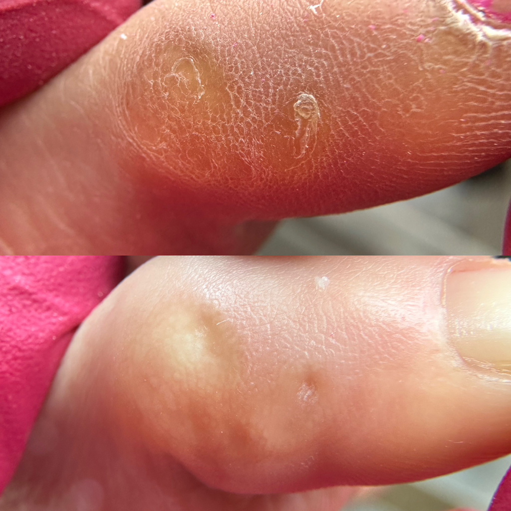 Обработка трещин, мазоль, натоптыши