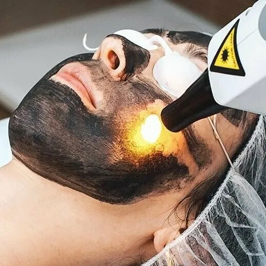 Карбоновый пилинг