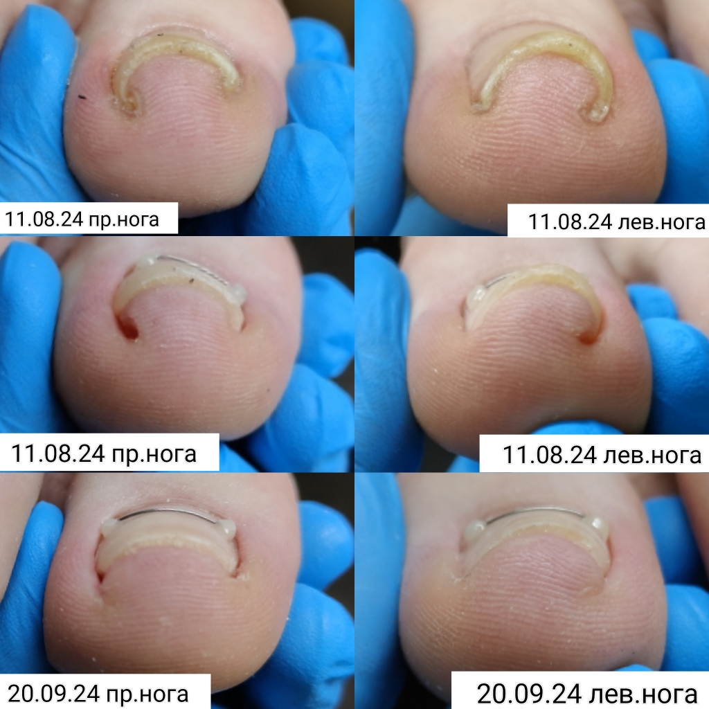 Установка титановой нити