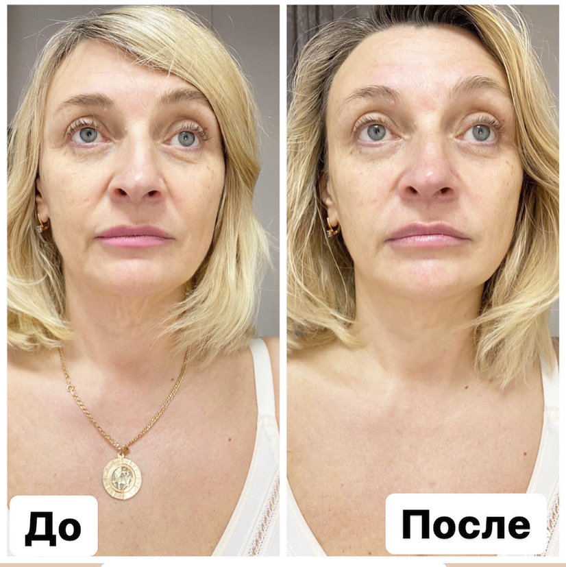 Лимфодренажный массаж лица
