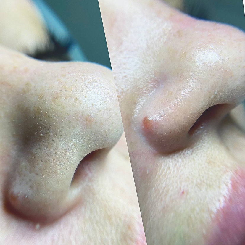 Чистка лица ультразвуковая