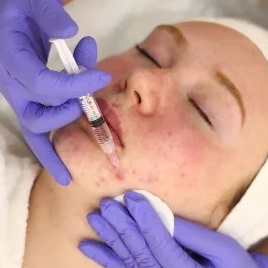 Биоревитализация