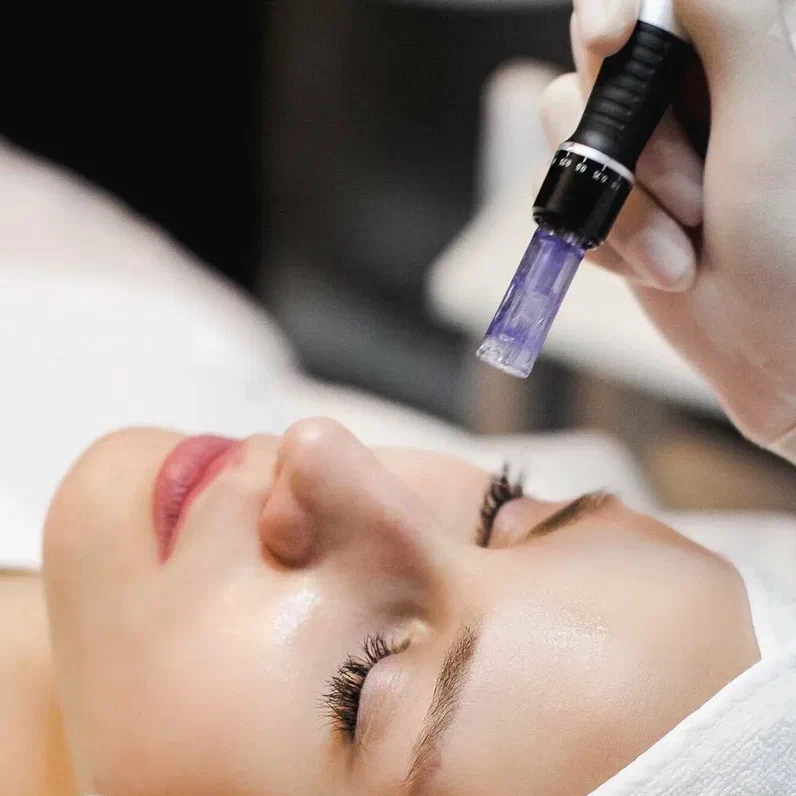 ФРАКЦИОННАЯ мезотерапия  ВСЕГО ЛИЦА