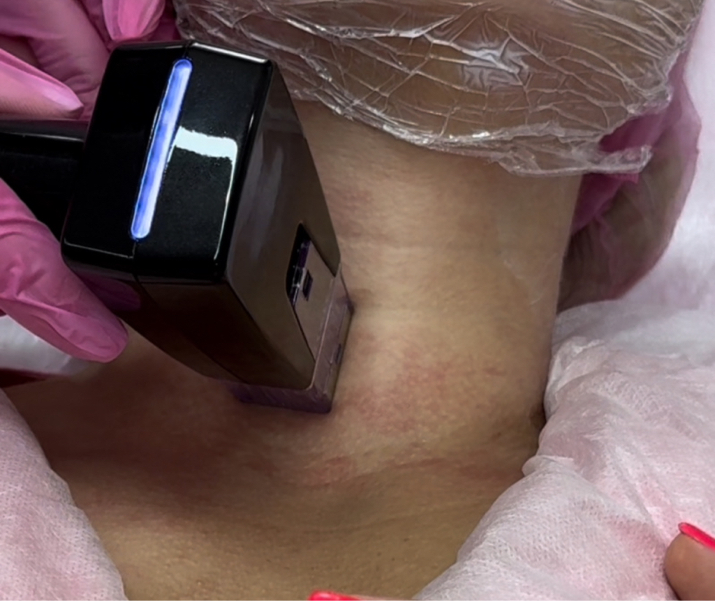 Фракционный игольчатый Rf-лифтинг (шея+декольте)