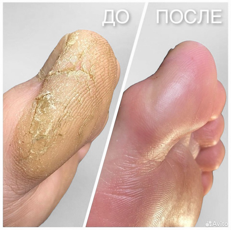 ПОЛНЫЙ БЕЗ ПОКРЫТИЯ (стопы + пальчики)