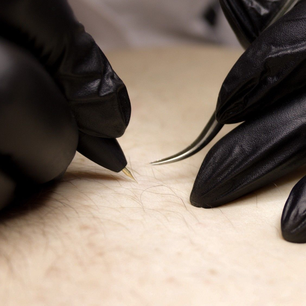 Глубокое бикини, межягодичная зона