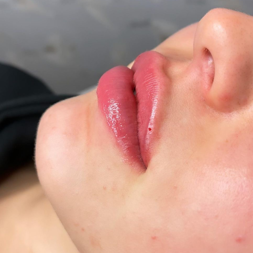 Увеличение губ