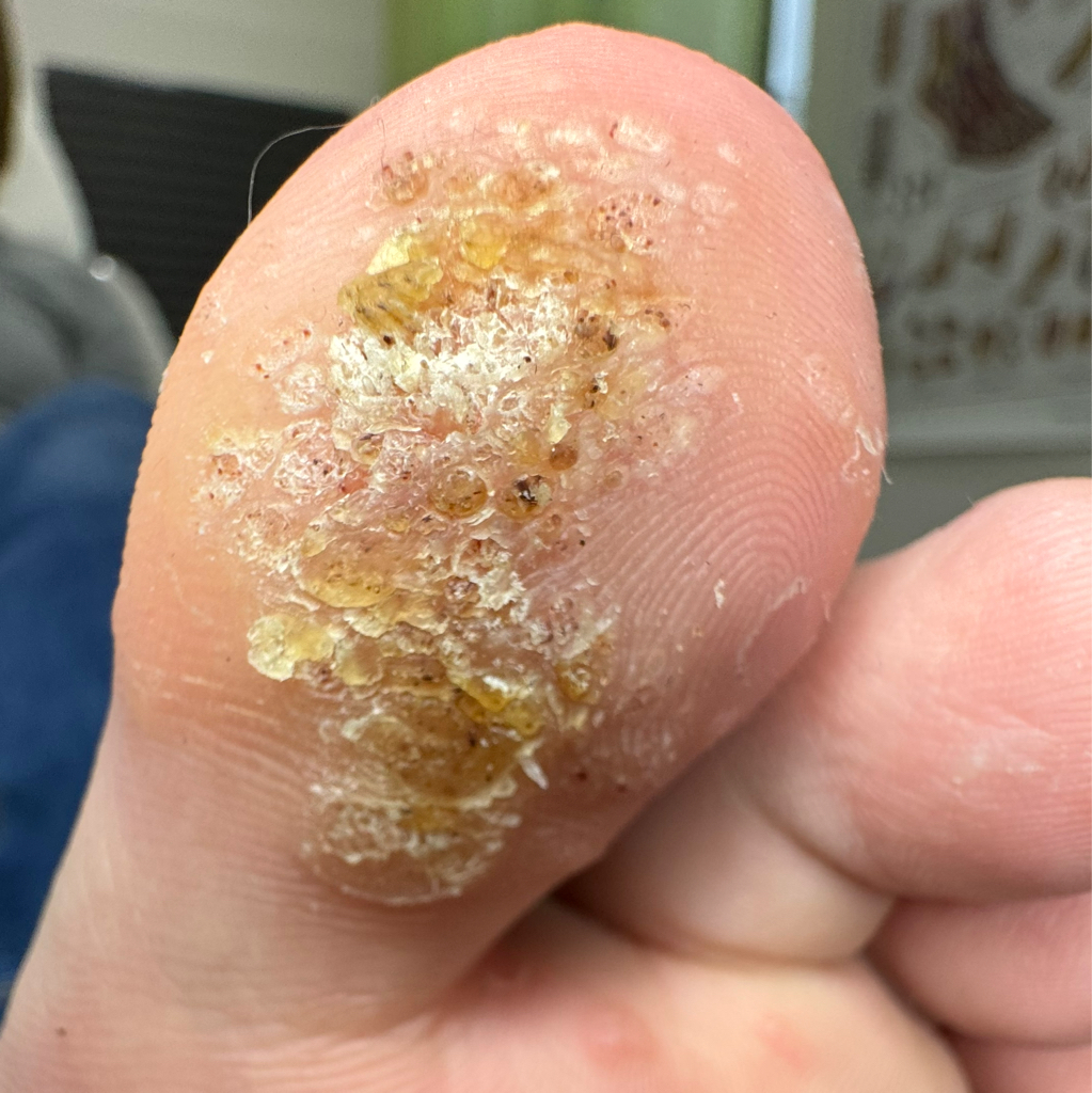 Обработка бородавки