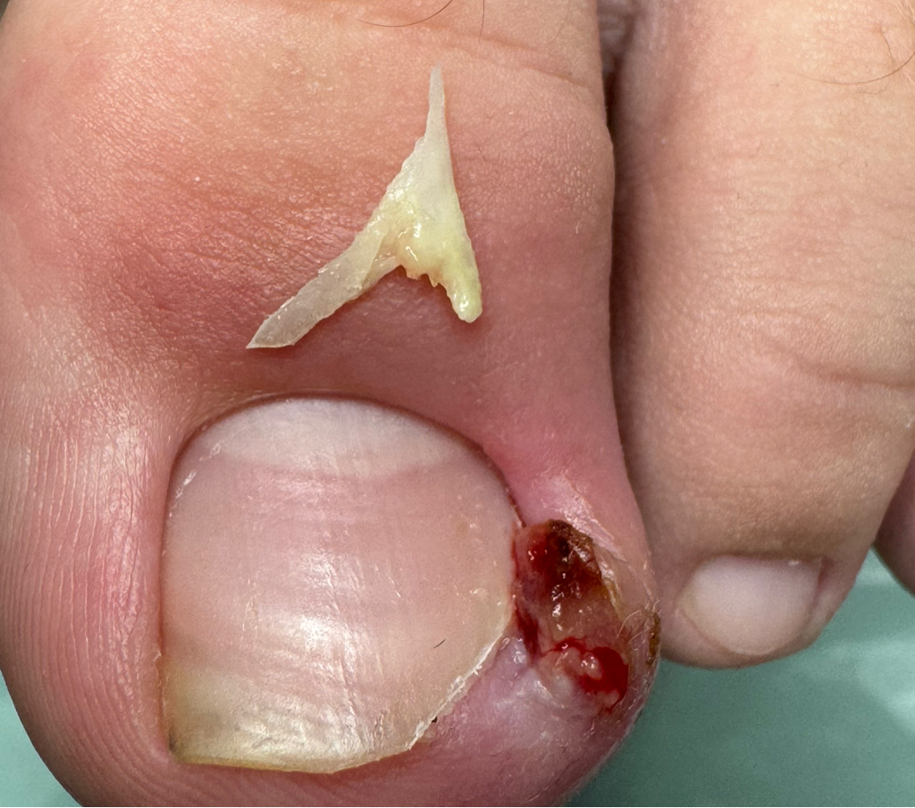 Вросший ноготь