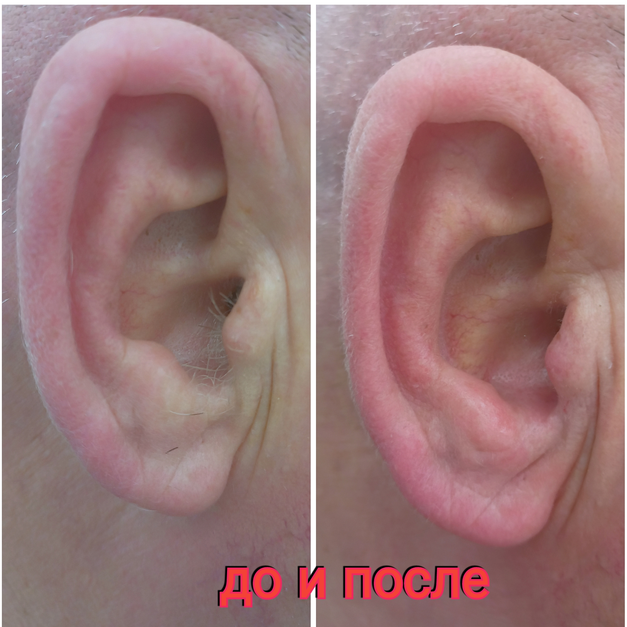 Скинс усики/подбородок/уши/нос