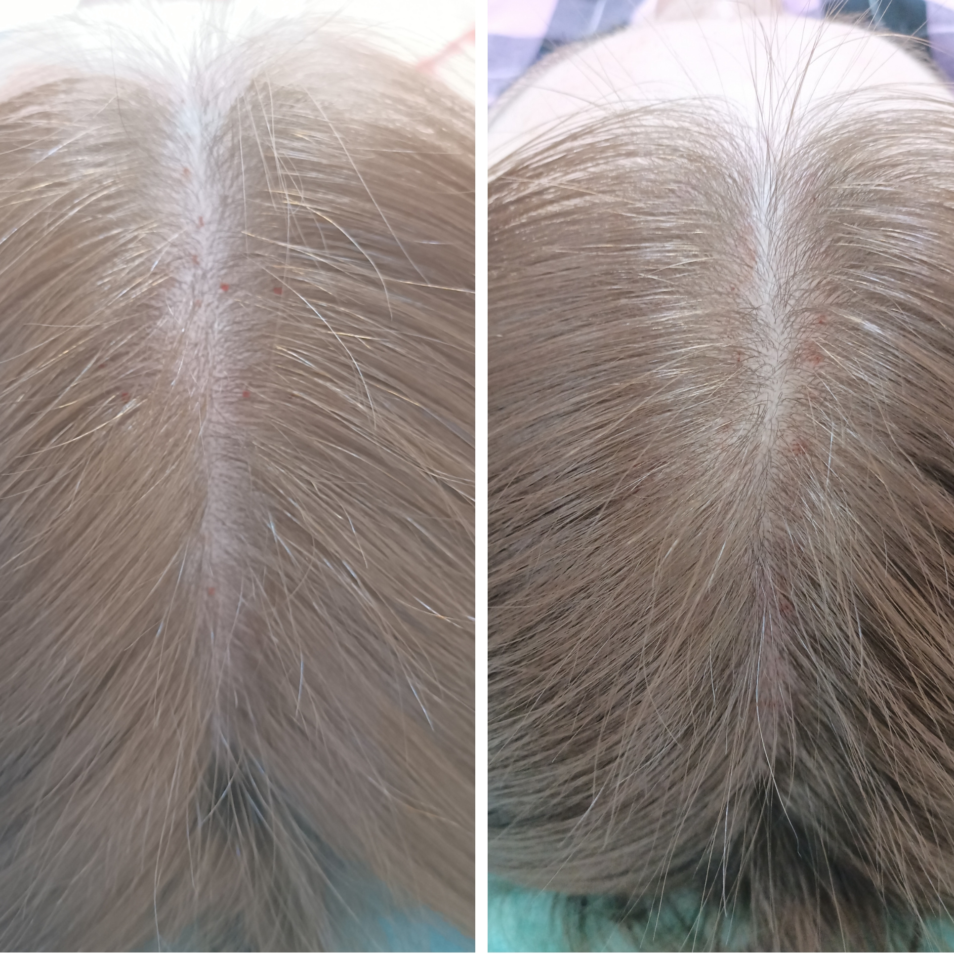 М. волосистой части головы