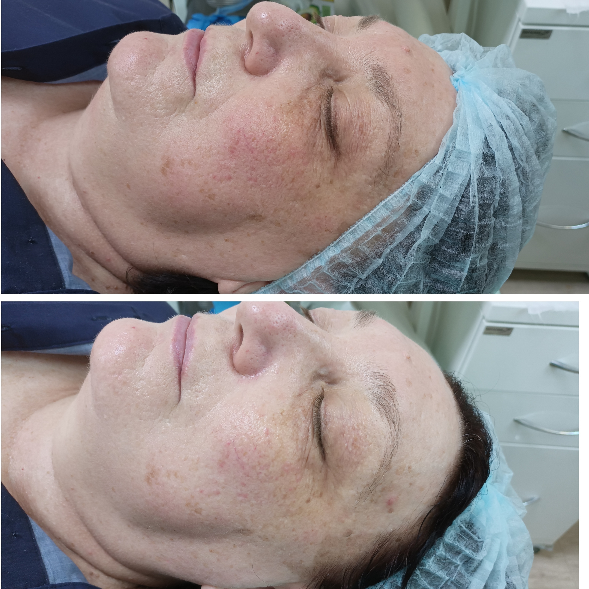 Химический пилинг ТСА 15%