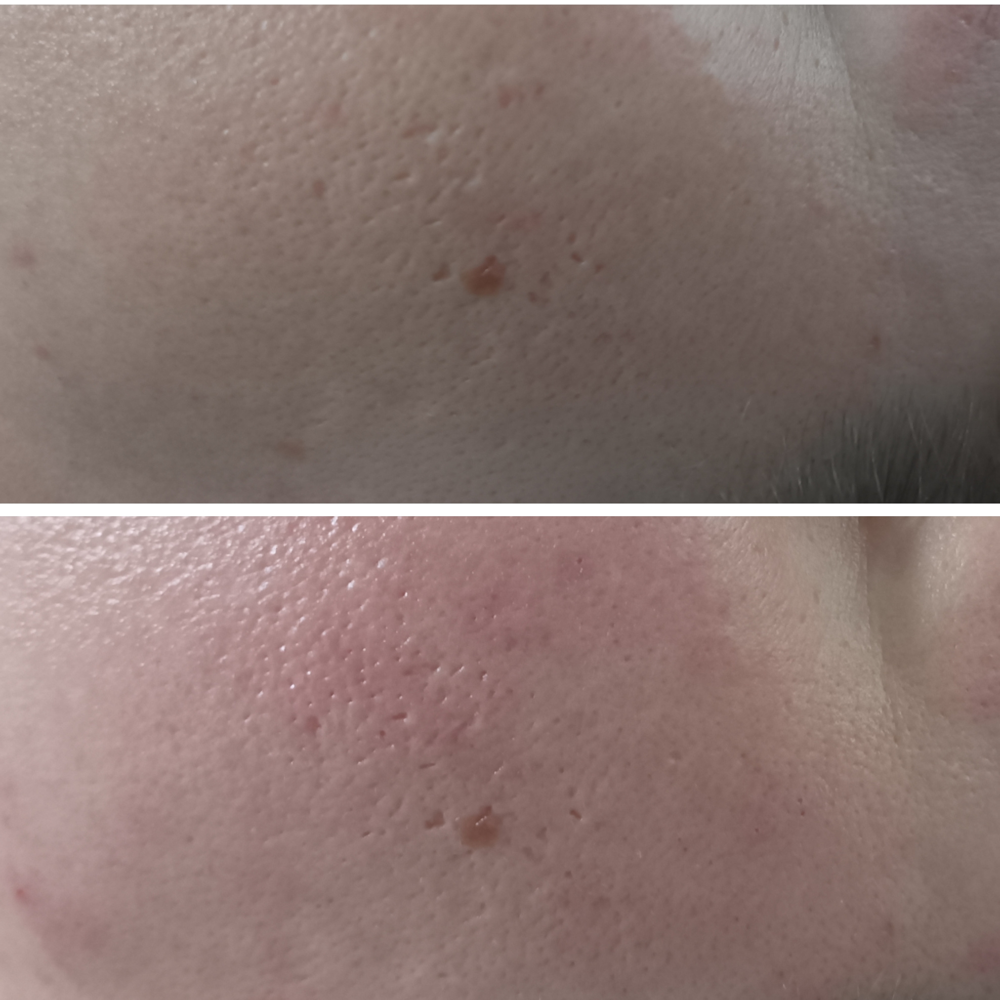 Чистка лица комбинированная