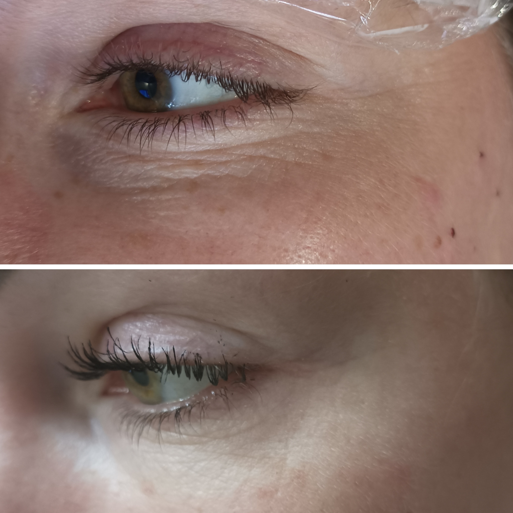 Коллагена терапия 7%