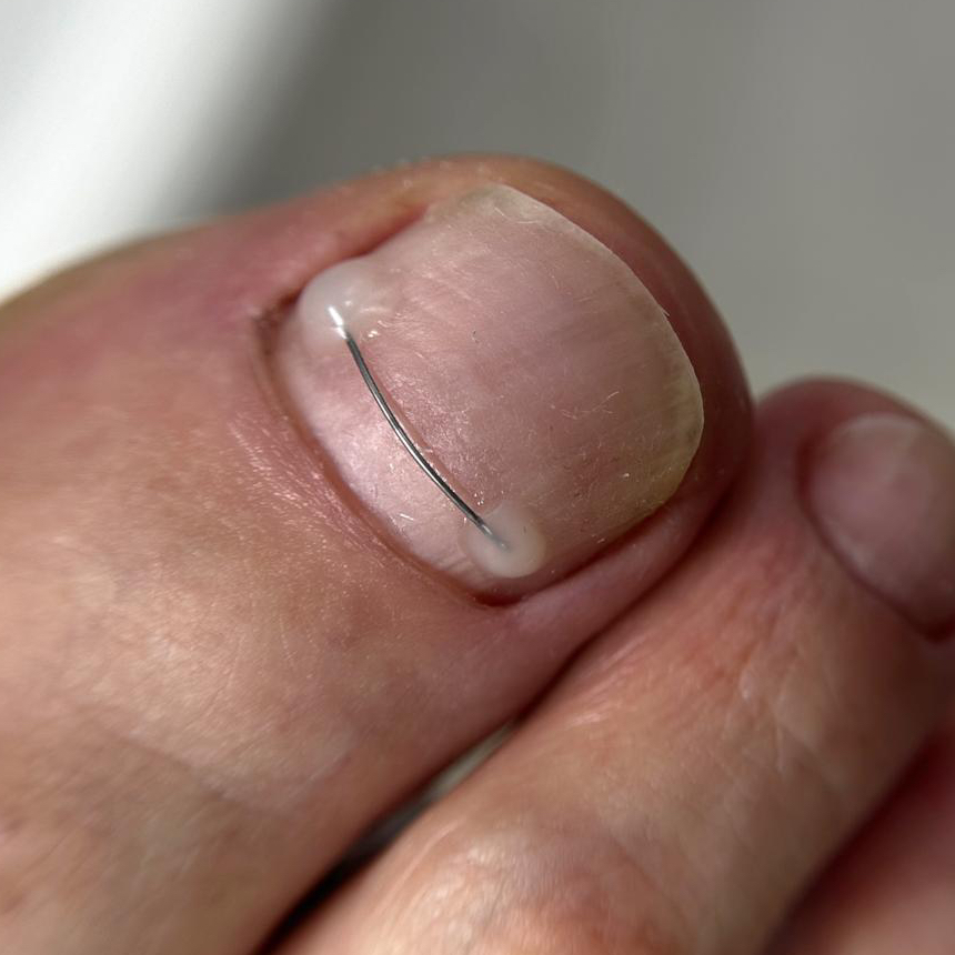 Коррекция титановой нити