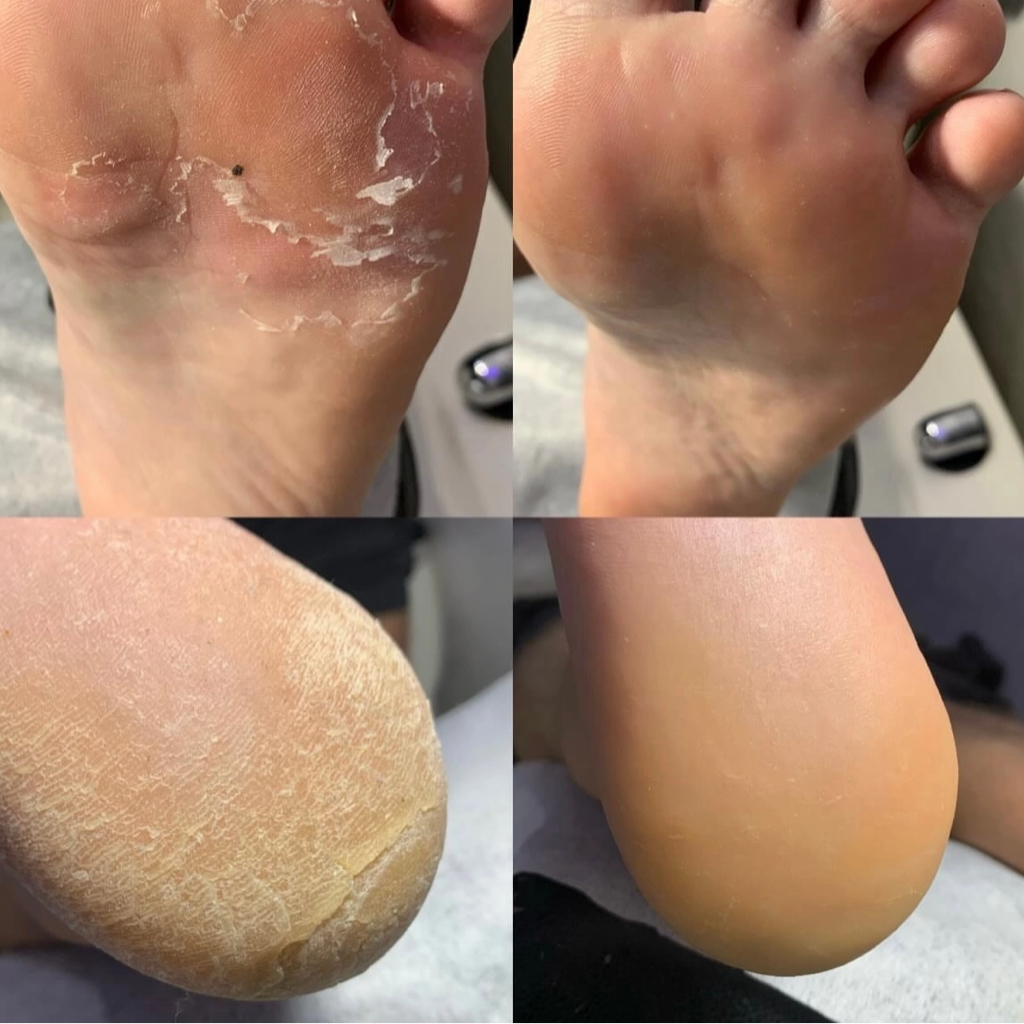 Педикюр подологический