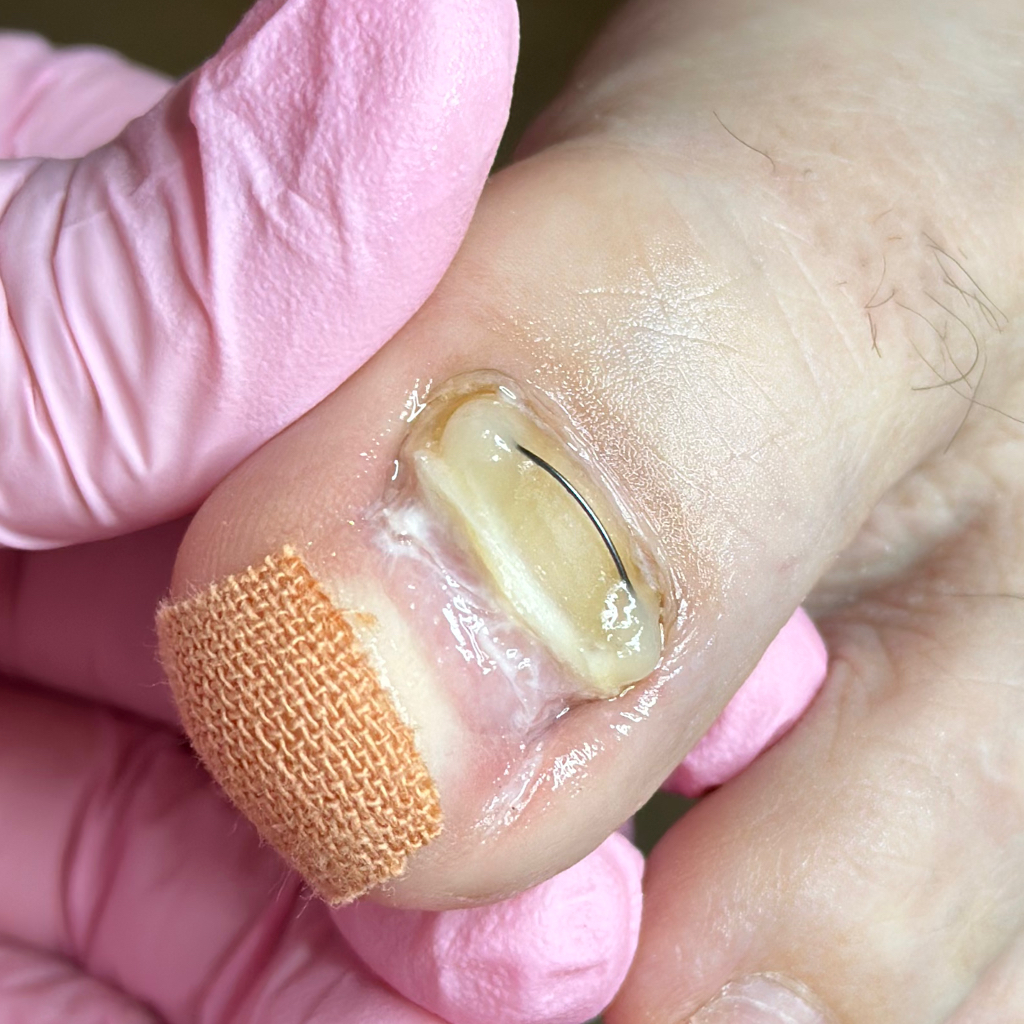 Установка титановой нити