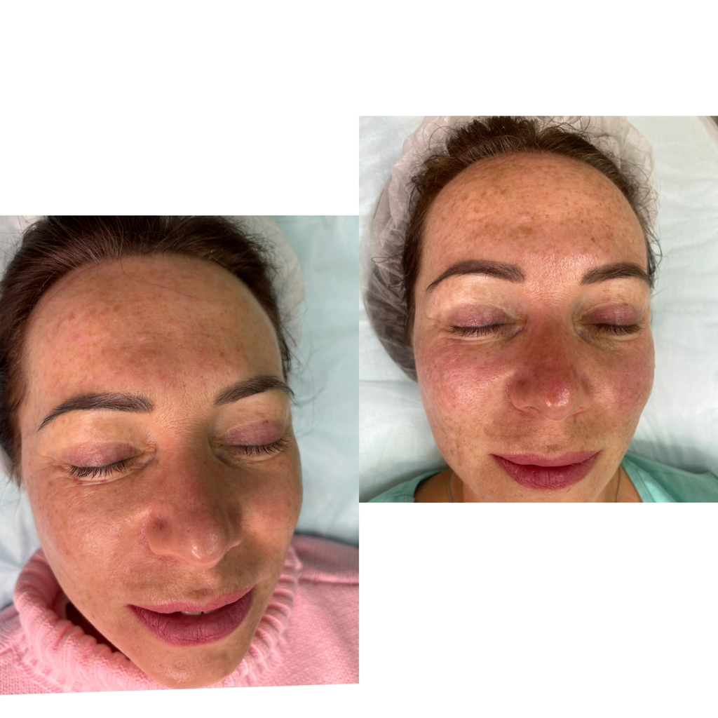 Биоревитализация -ФранцияCytocare