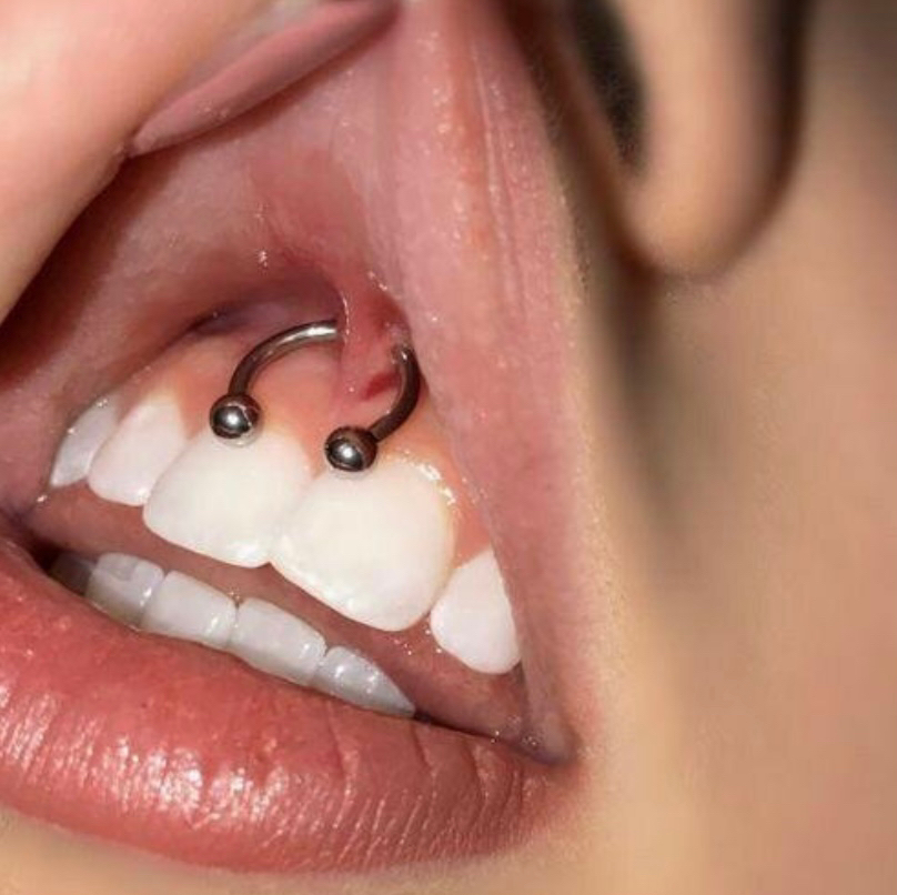 Прокол Смайл