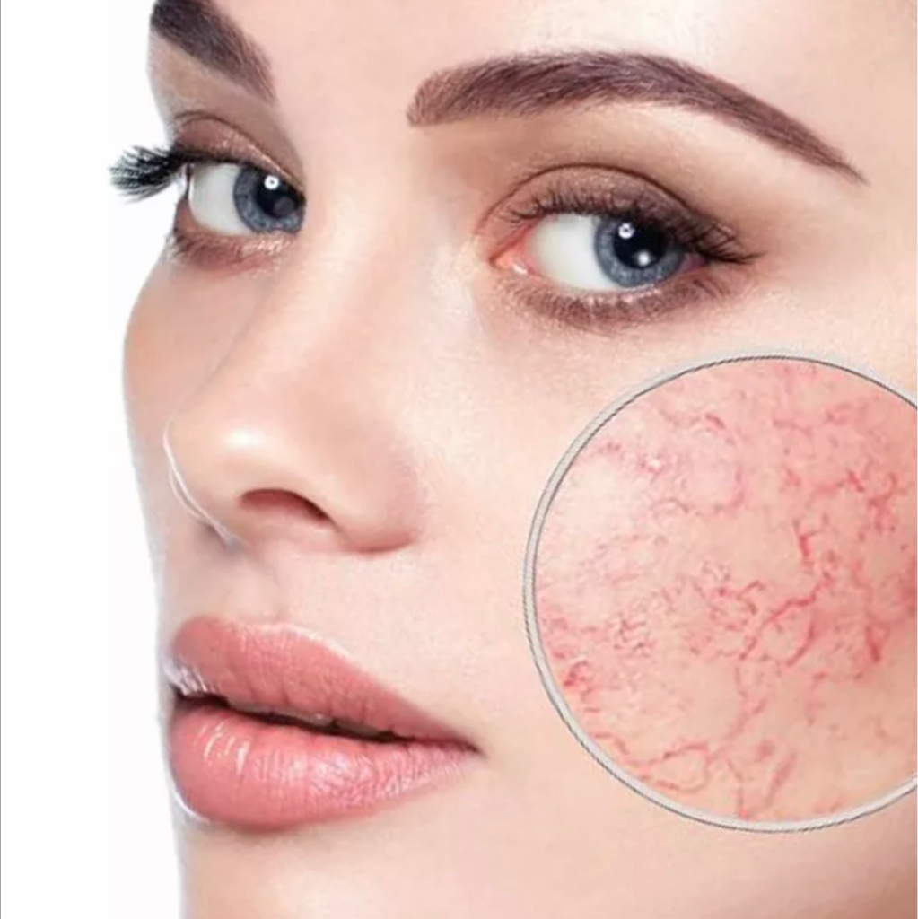 Удаление сосудистой сетки на лице