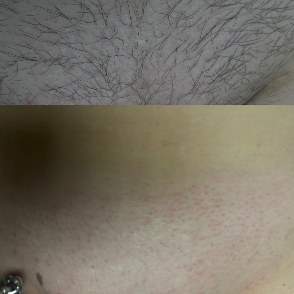 Бикини Тотал  Микс Сахар/Воск