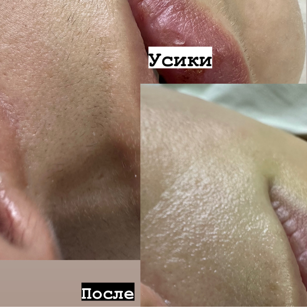 Верхняя губа / подбородок / бакенбарды Skin’s