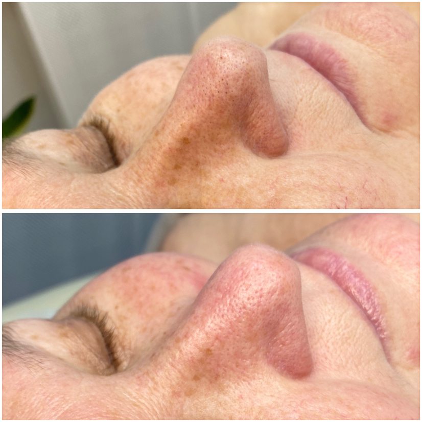 SOFT CLEAN set (мягкое очищение) На препаратах SOIN с использованием аппаратных и инструмен- тальных методик: мягкая чистка для лица.