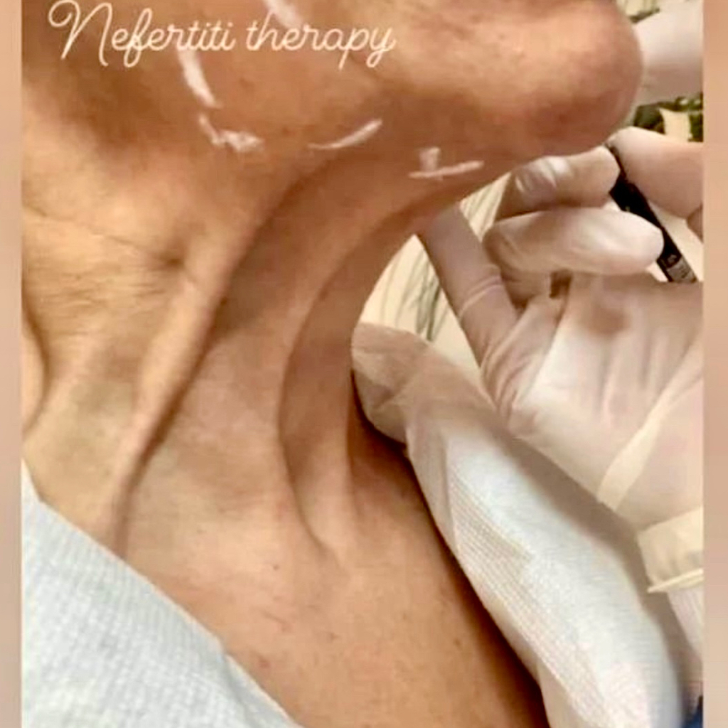BOTOX-NEFERTITI