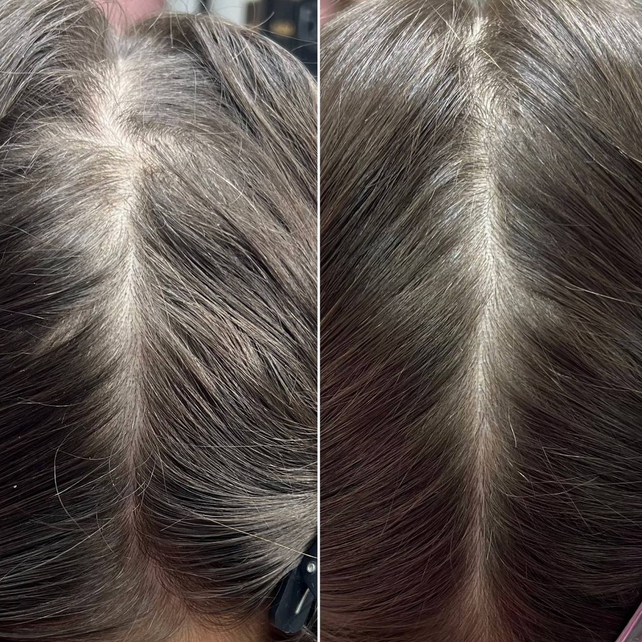 Микронидлинг (разовая)