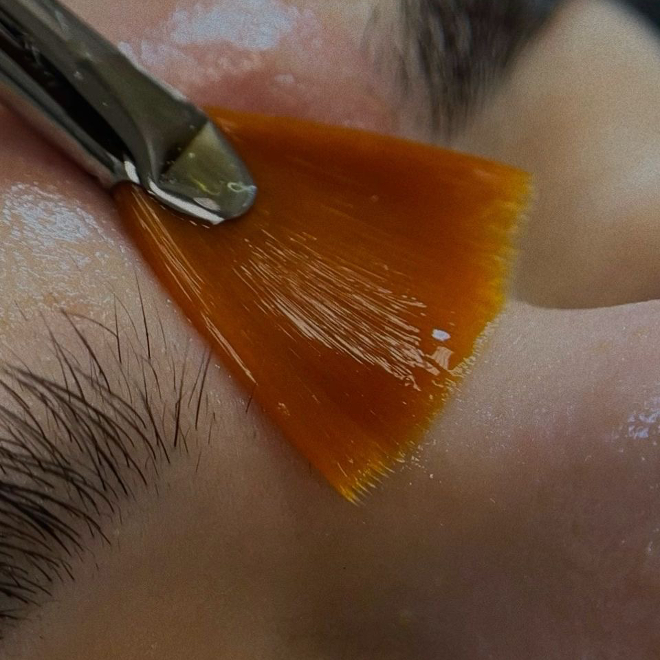 Пилинг мультикислотный