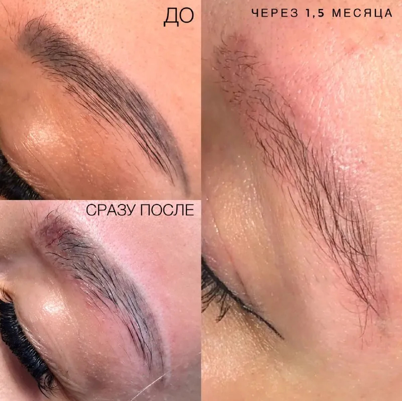 Удаление татуажа