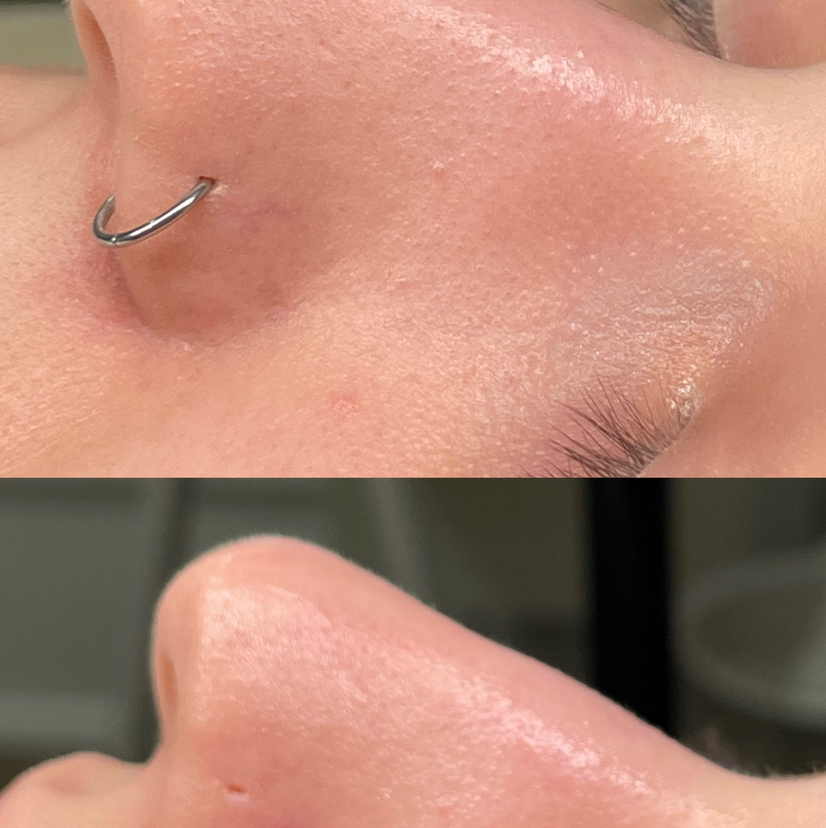 ЧИСТКА ЛИЦА комбинированная с использованием аппаратной(ультразвуковой)и инструментальной методики удаления комедонов.