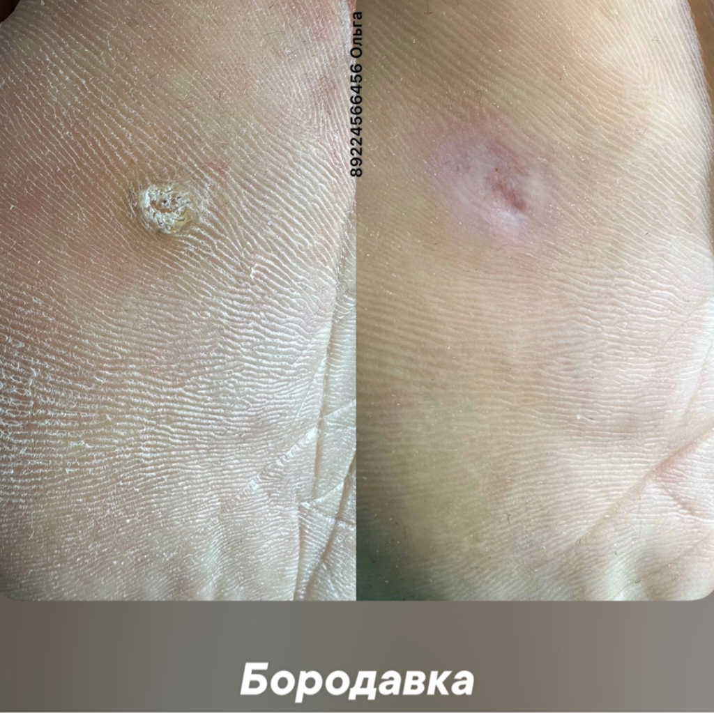 Подология Безопасная и безболезненная работа с бородавками (ВПЧ)