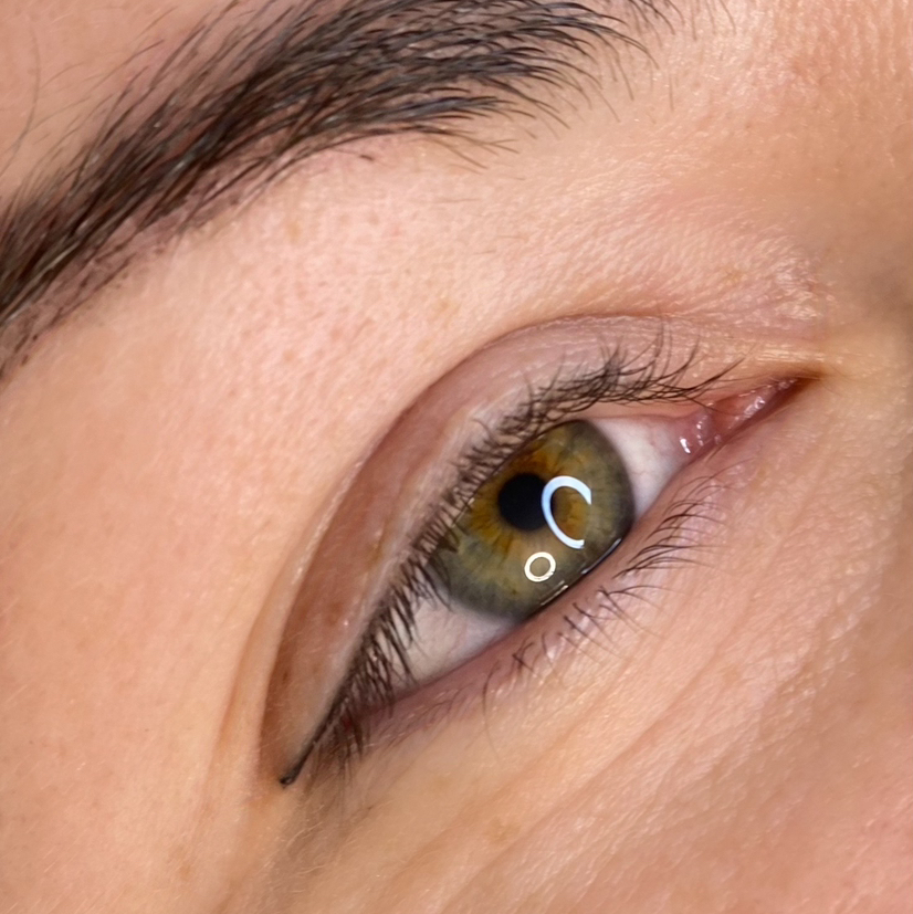 Коррекция межреснички