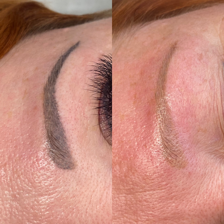 Удаление татуажа лазером