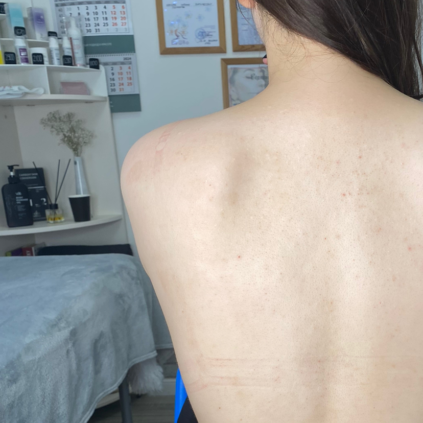 Чистка спины