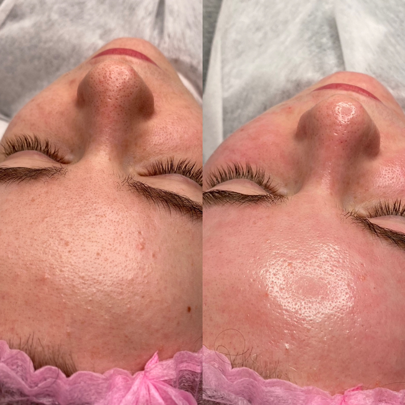 Чистка лица + пилинг