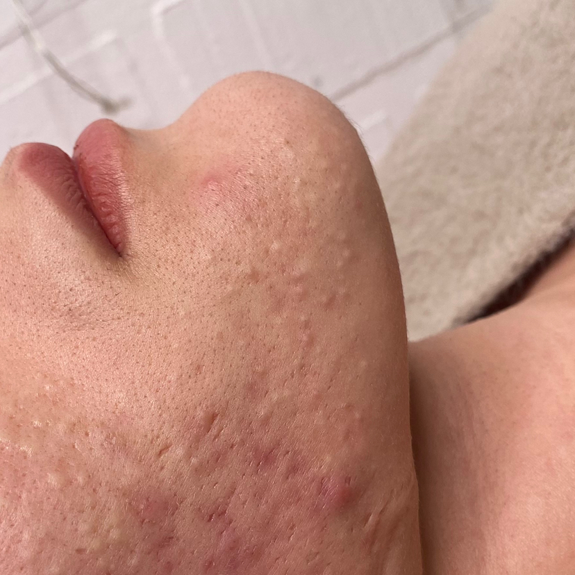 Сухая чистка лица