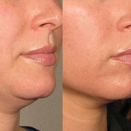 Липолитики