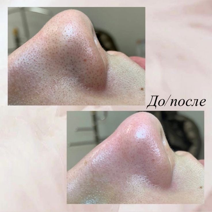 Ультразвуковая чистка лица