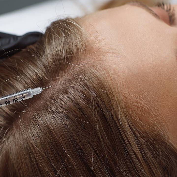 Мезотерапия волосистой части головы