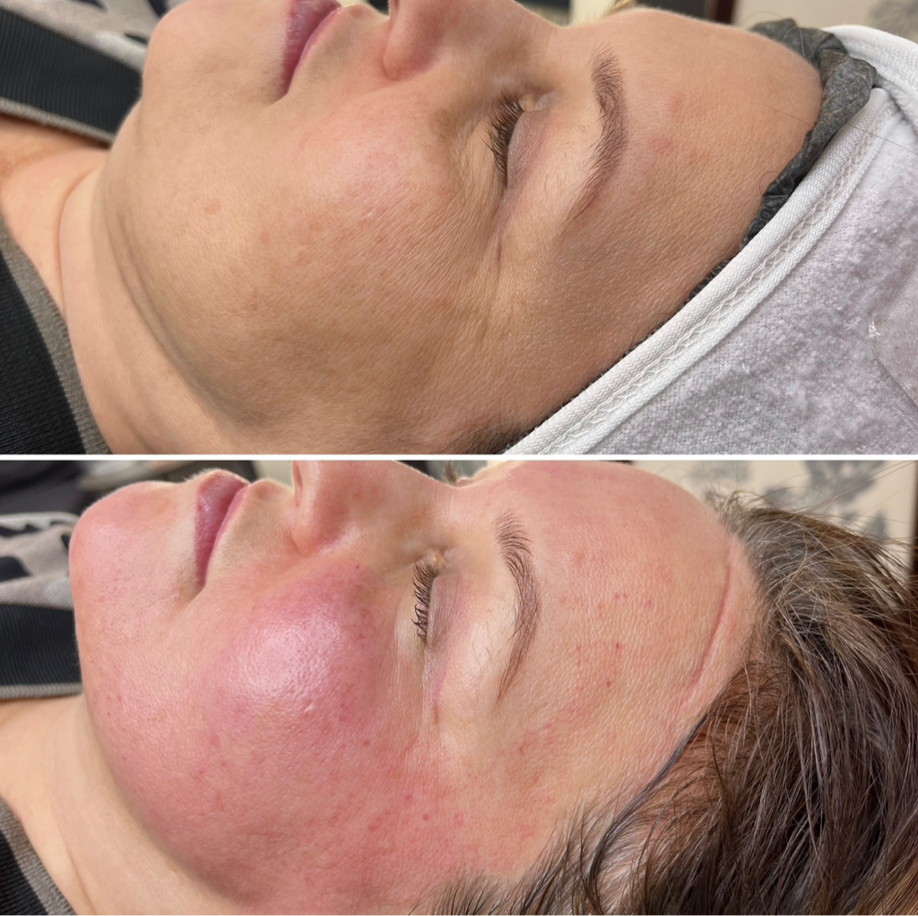 Микро игольчатый  РФ