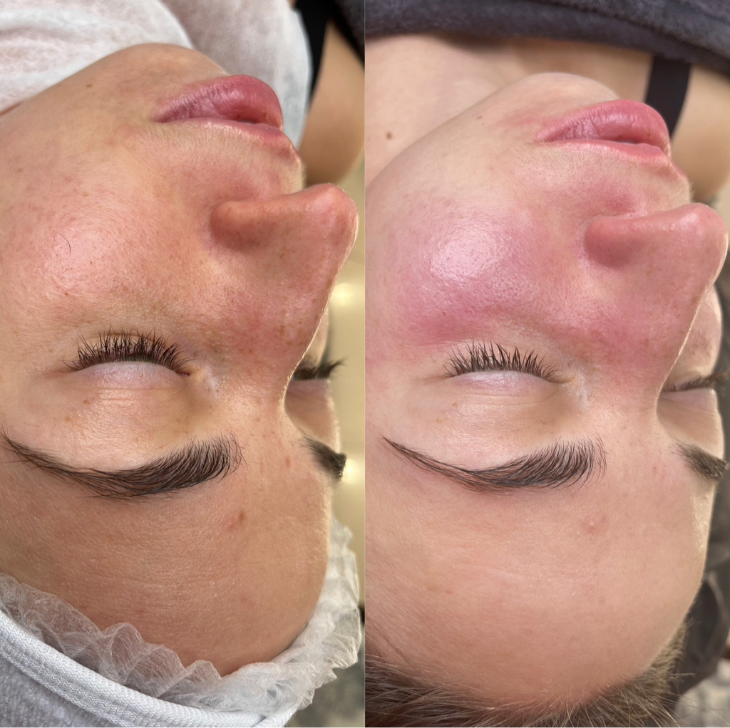 Hydrafacial
